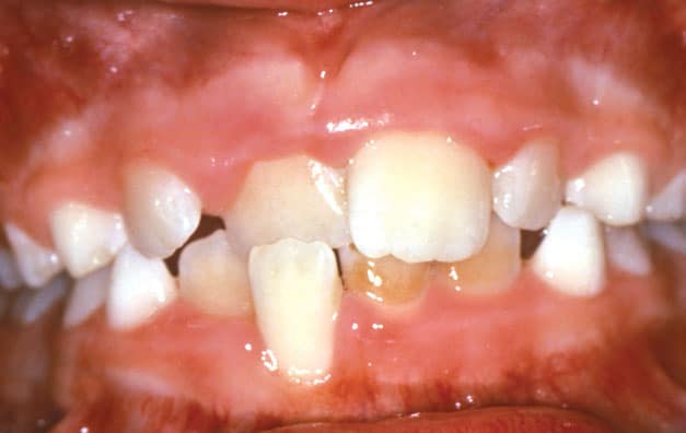 Crossbite Sacramone Orthodontics in Newtonville, MA