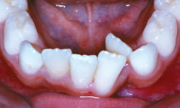Crowding Sacramone Orthodontics in Newtonville, MA