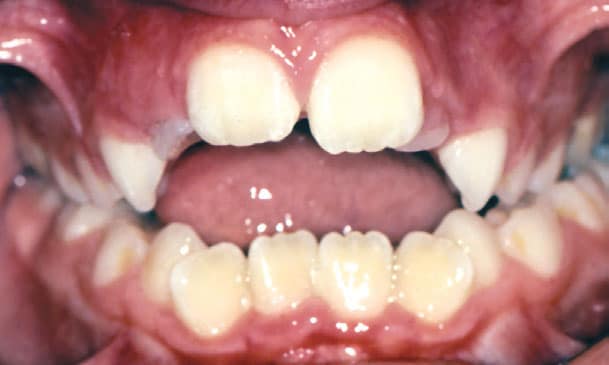 Open Bite Sacramone Orthodontics in Newtonville, MA