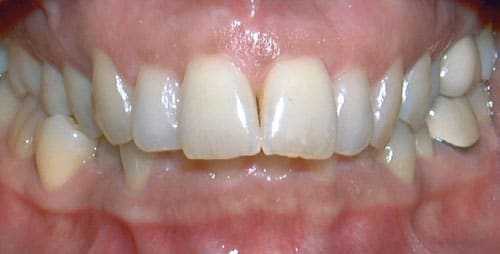 Overbite Sacramone Orthodontics in Newtonville, MA