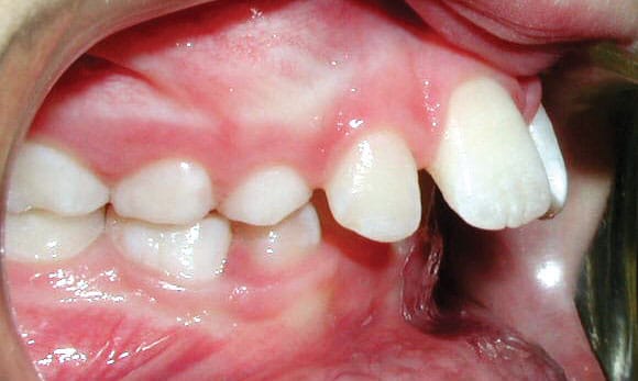 Protrusion Sacramone Orthodontics in Newtonville, MA