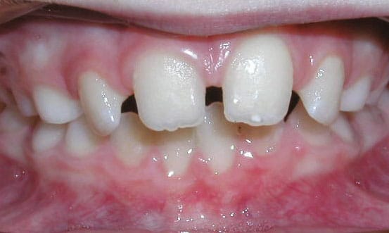 Spacing Sacramone Orthodontics in Newtonville, MA