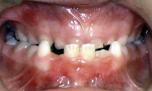 Underbite Sacramone Orthodontics in Newtonville, MA